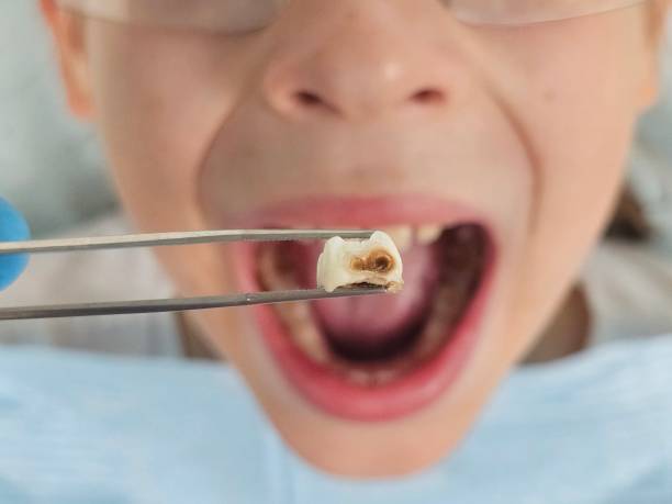 Best Knocked-Out Tooth (Avulsed Tooth) Treatment in Yorketown, NJ